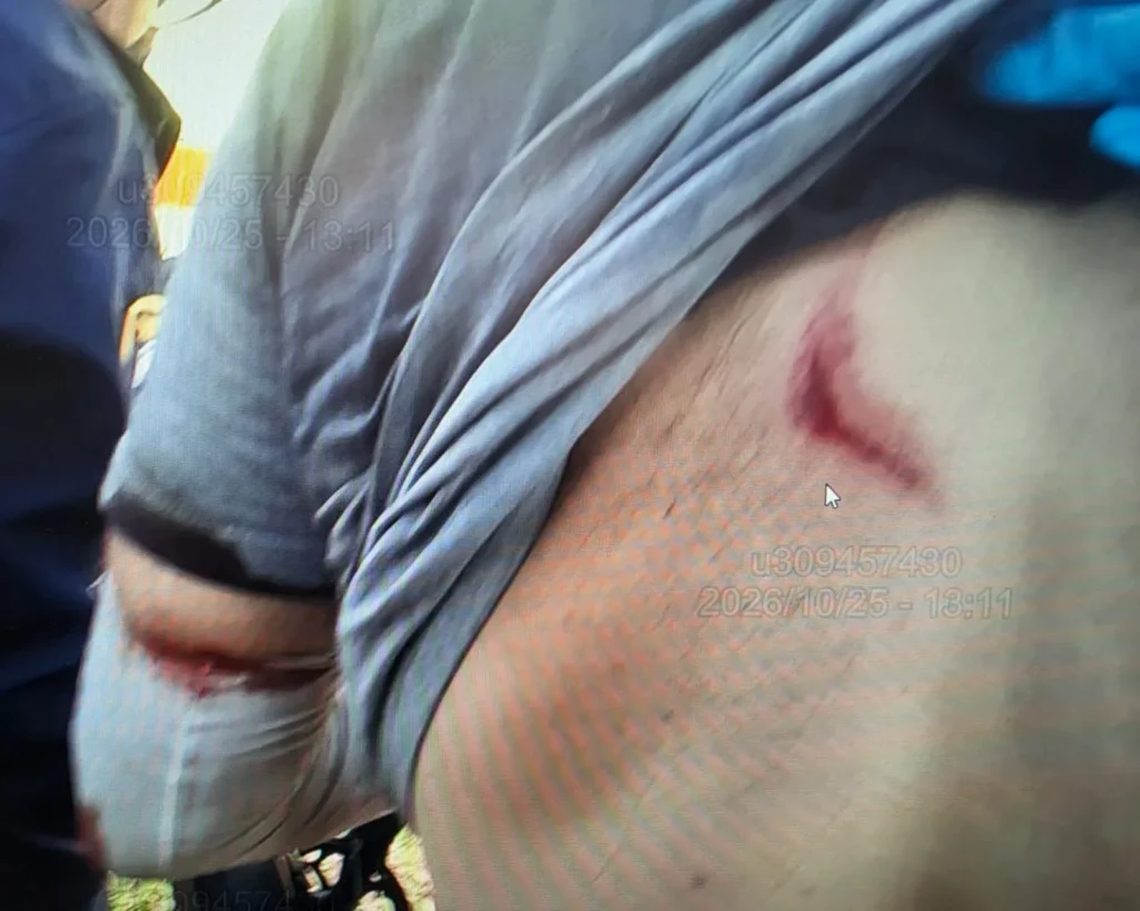 Red cut on the courier's back, with his gray shirt pulled up